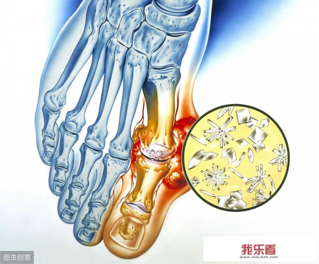 尿酸高的人不宜吃什么？