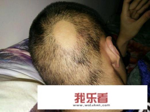 我头上的一块头发掉了该吃哪些药物让新头发长出呢？