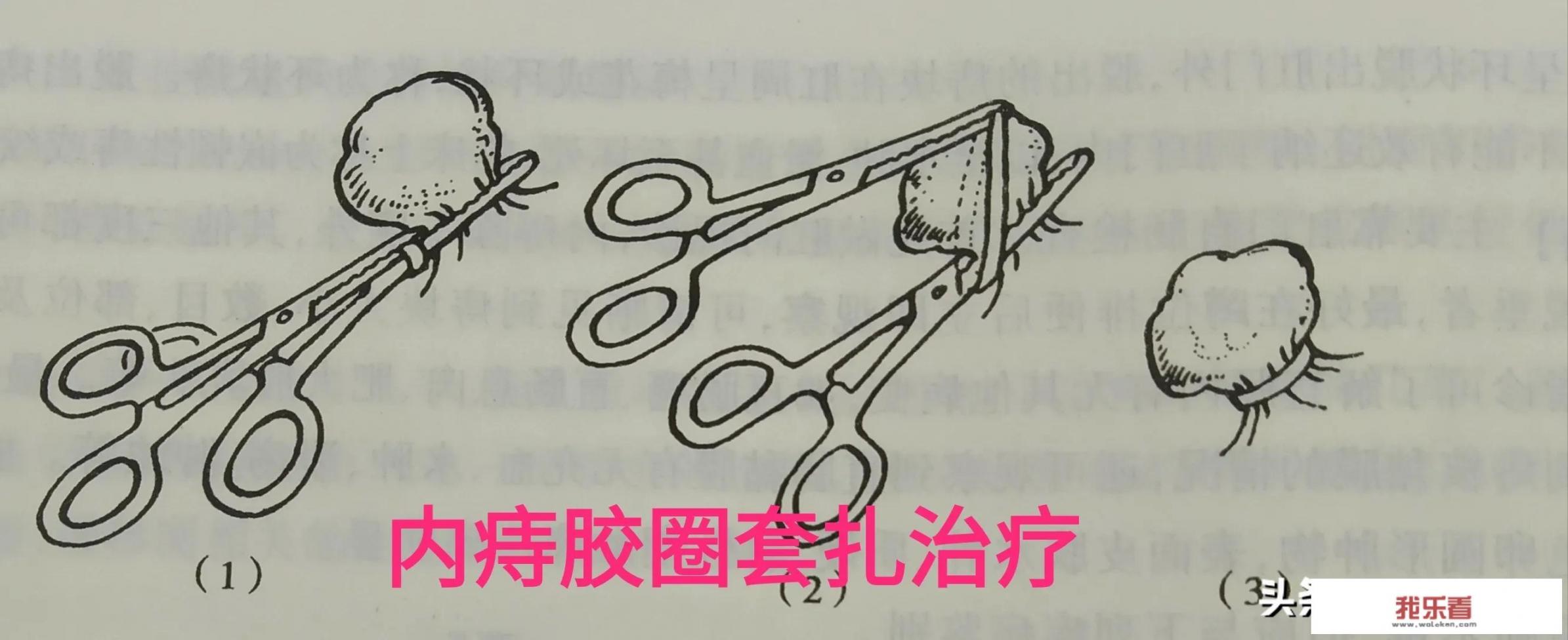 治疗痔疮有哪些秘方推荐？