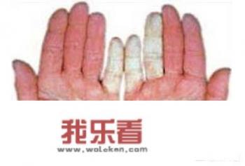 什么是雷诺病？