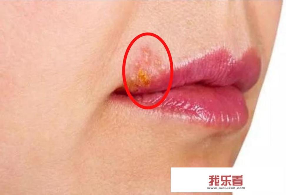 嘴唇上长泡该怎么消除？