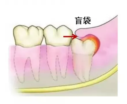 什么是智齿？
