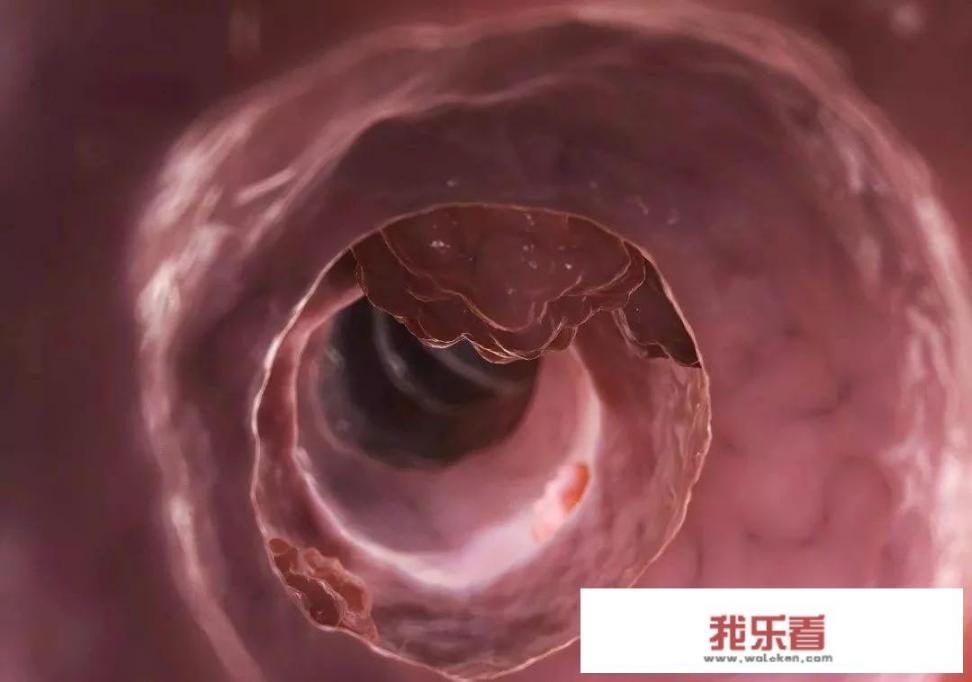 排便时出现的“4种异常”，千万别忽略，很可能是肠癌找上门，你知道哪4点吗？